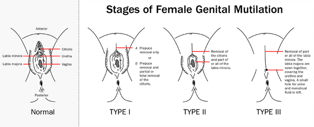 Types of FGM