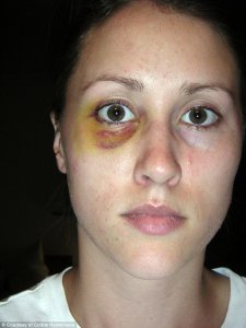 Colbie Holderness, first wife of Rob Porter, with a black eye,